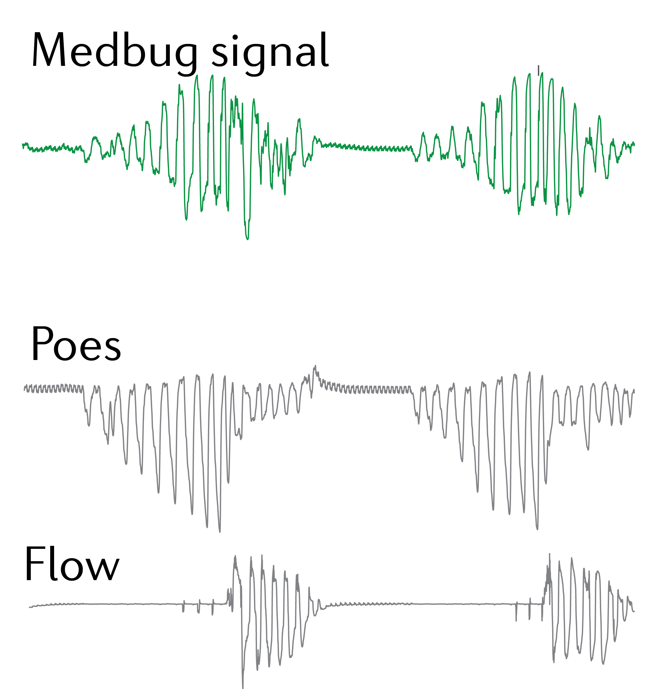 AHI visual — mattress signal traces used for overnight breathing-event scoring